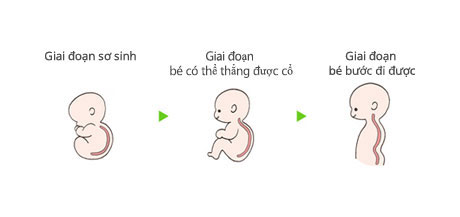 Cơ thể b&eacute; cong h&igrave;nh chữ C